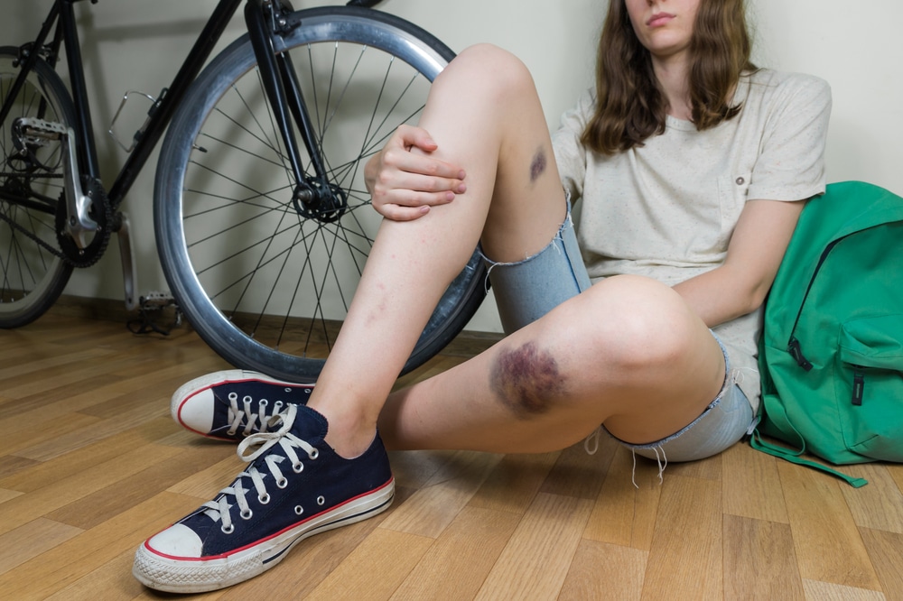 Kā veiksmīgi tikt galā ar nelielām traumām?